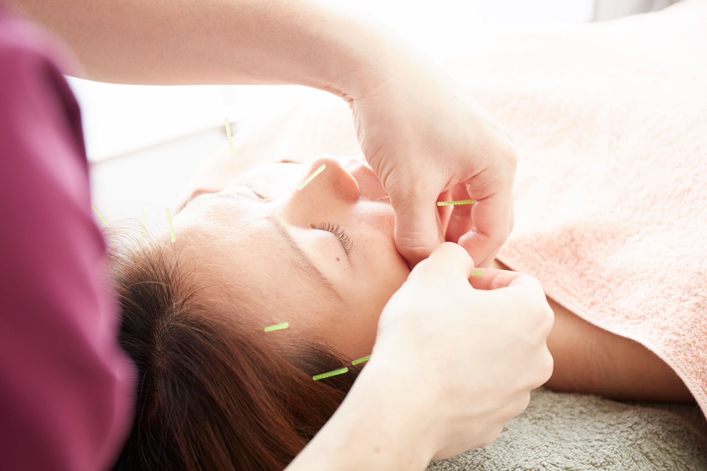 HE DiMEの美容鍼イメージ